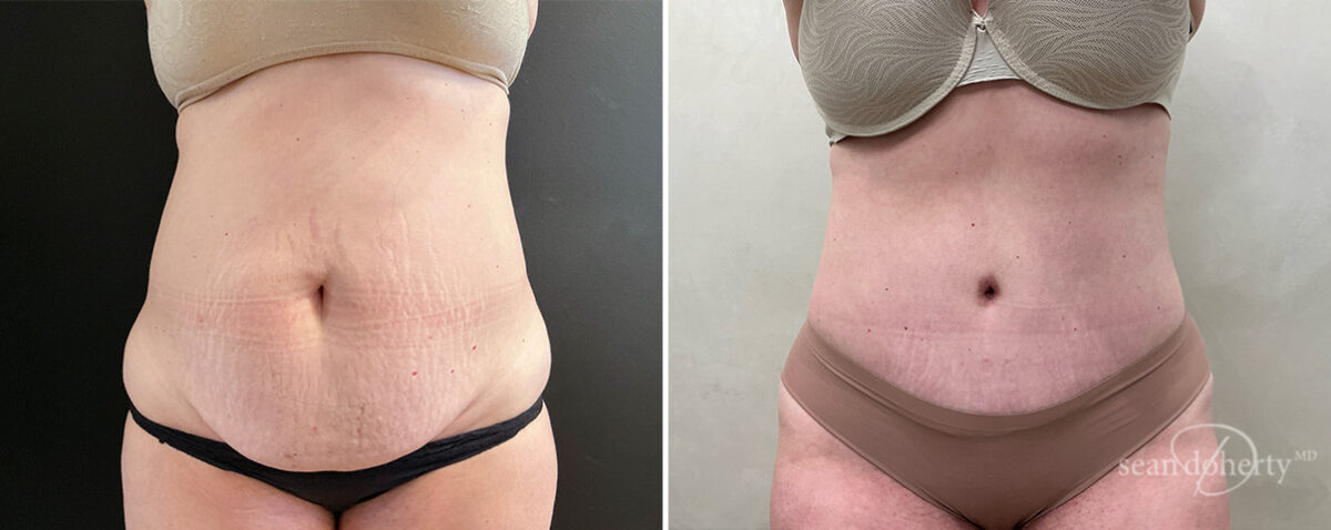 Tummy Tuck Before and After Photos in Boston, MA, Patient 14422