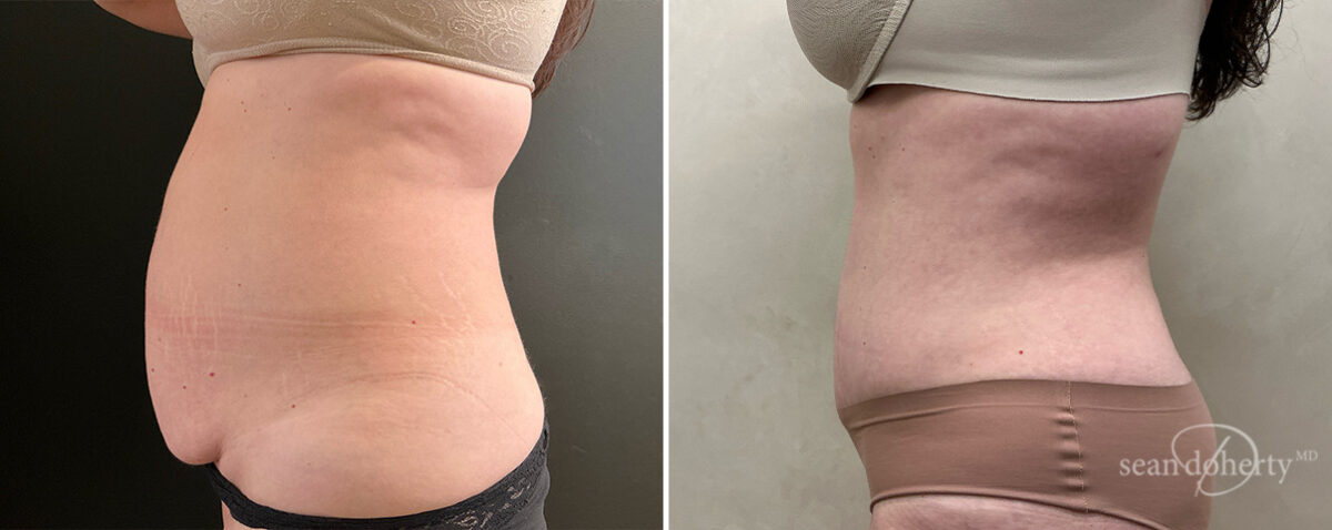 Tummy Tuck Before and After Photos in Boston, MA, Patient 14422