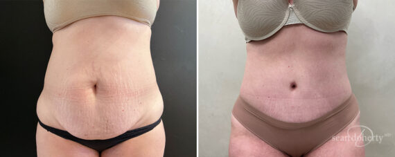 Tummy Tuck Before and After Photos in Boston, MA, Patient 14422