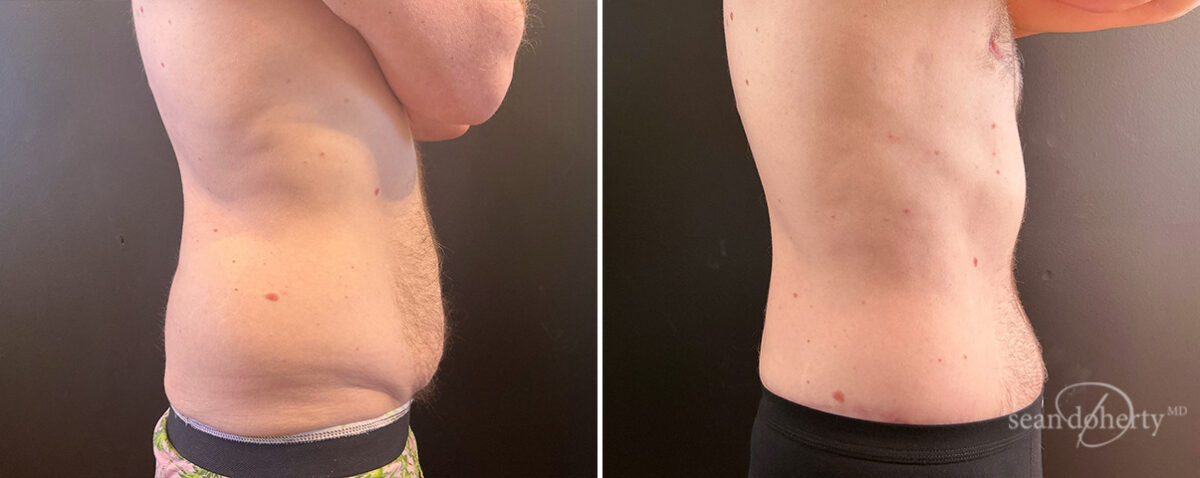 Tummy Tuck Before and After Photos in Boston, MA, Patient 14432
