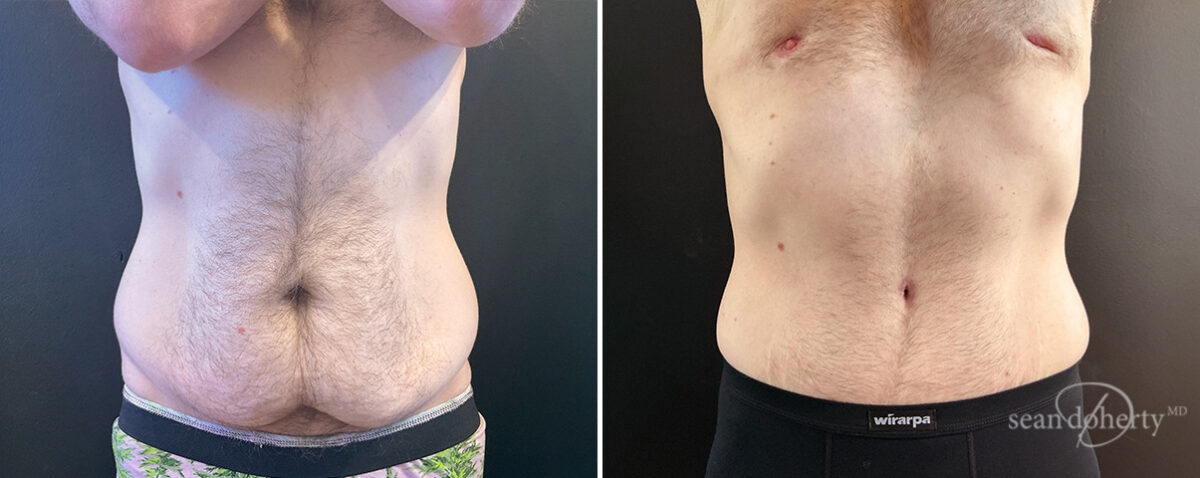 Tummy Tuck Before and After Photos in Boston, MA, Patient 14432