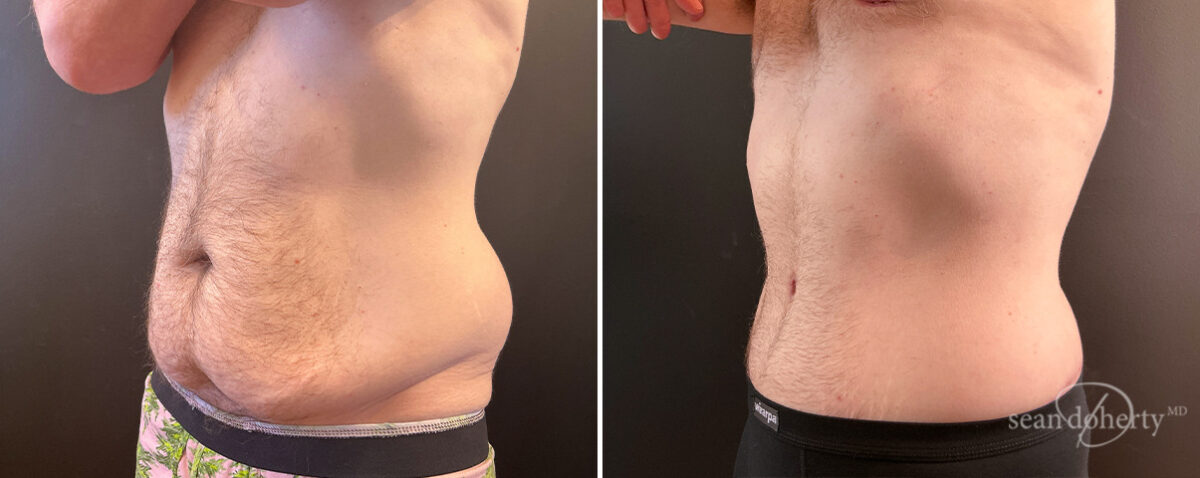 Tummy Tuck Before and After Photos in Boston, MA, Patient 14432