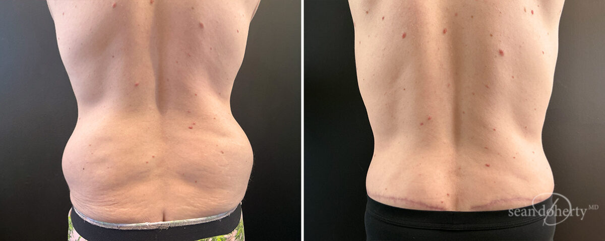 Tummy Tuck Before and After Photos in Boston, MA, Patient 14432