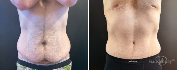 Tummy Tuck Before and After Photos in Boston, MA, Patient 14432