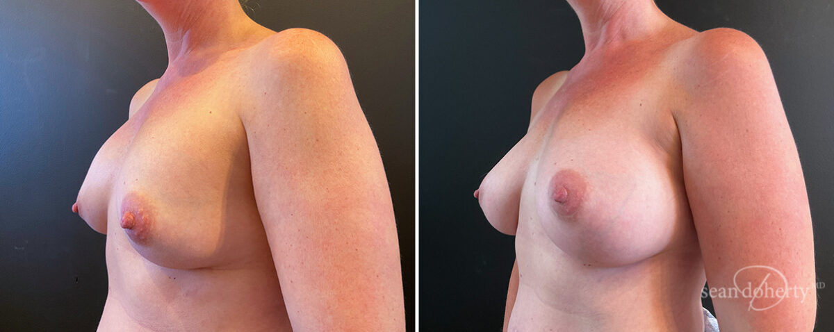 Breast Implant Exchange Before and After Photos in Boston, MA, Patient 14487