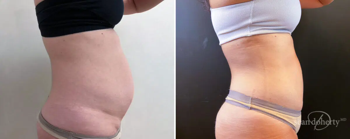Liposuction Before and After Photos in Boston, MA, Patient 14497