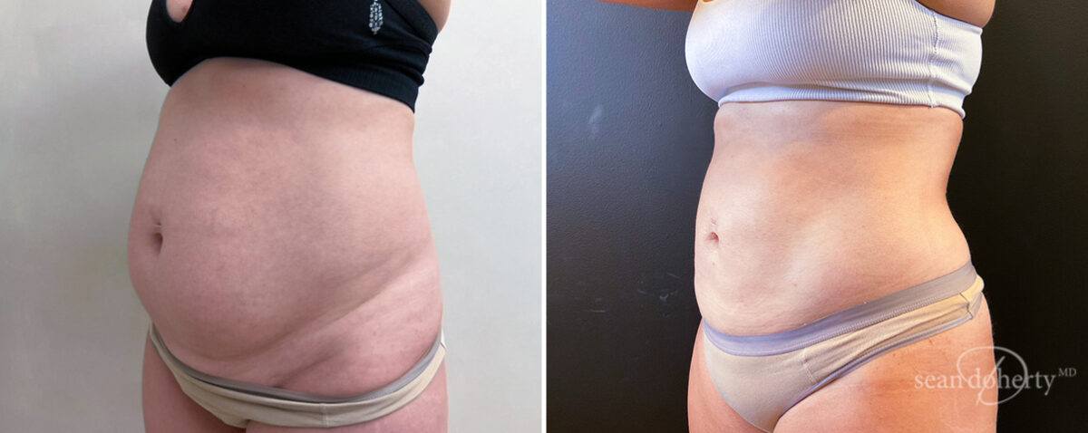 Liposuction Before and After Photos in Boston, MA, Patient 14497