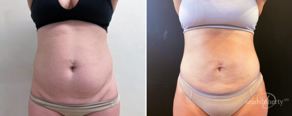 Liposuction Before and After Photos in Boston, MA, Patient 14497
