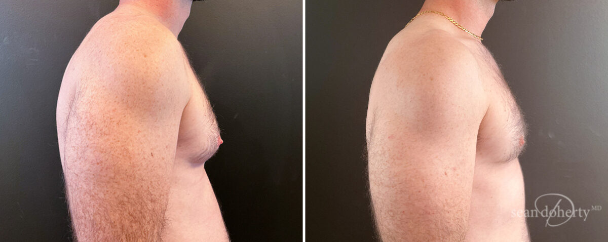 Gynecomastia Before and After Photos in Boston, MA, Patient 14507