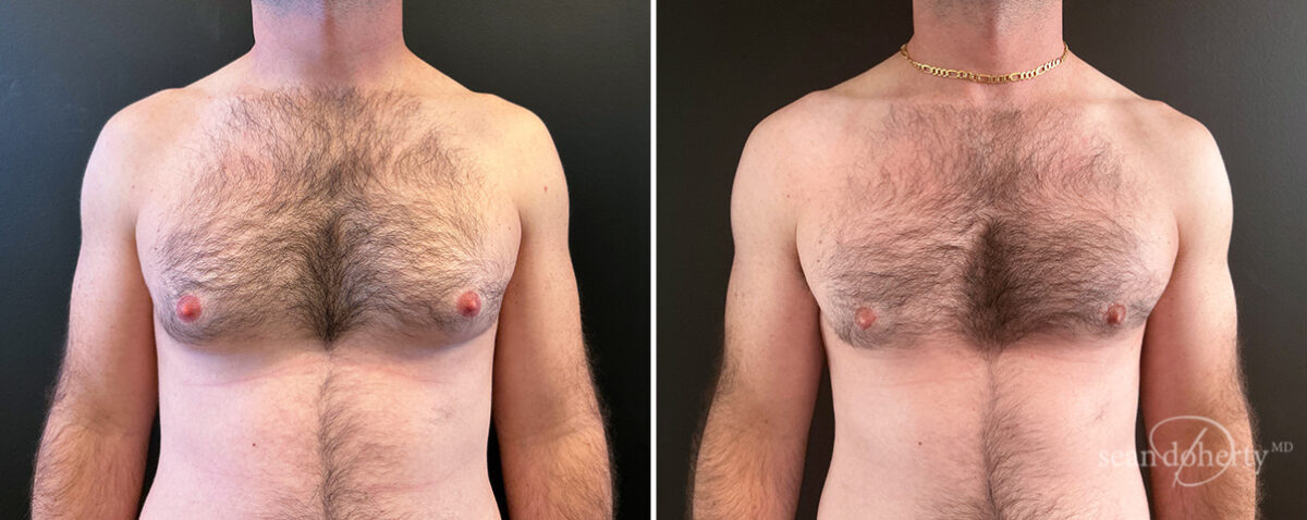 Gynecomastia Before and After Photos in Boston, MA, Patient 14507