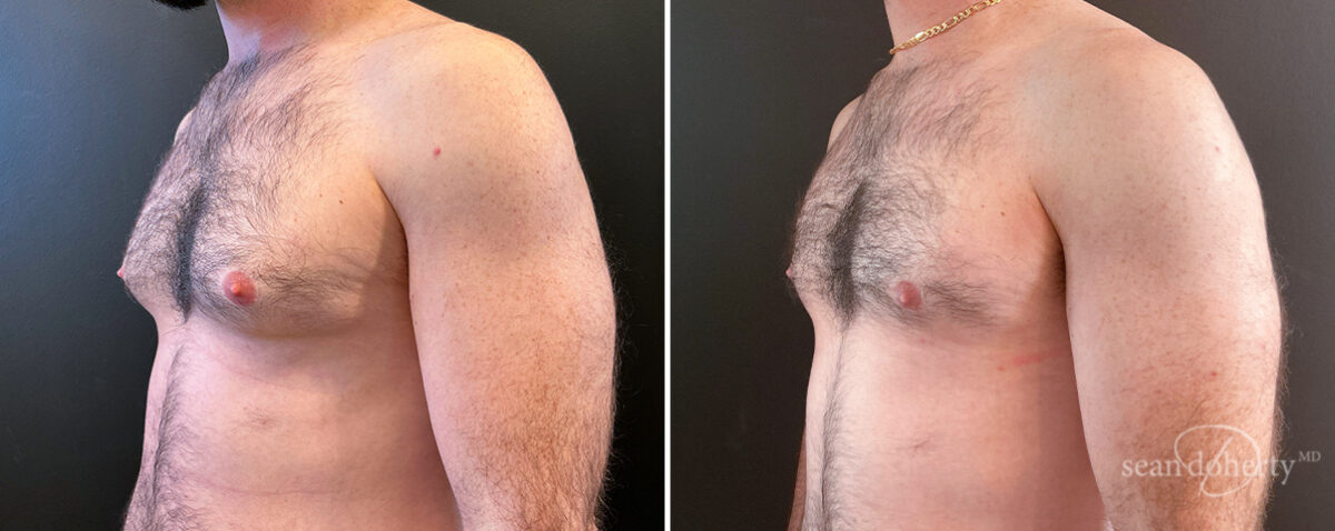 Gynecomastia Before and After Photos in Boston, MA, Patient 14507