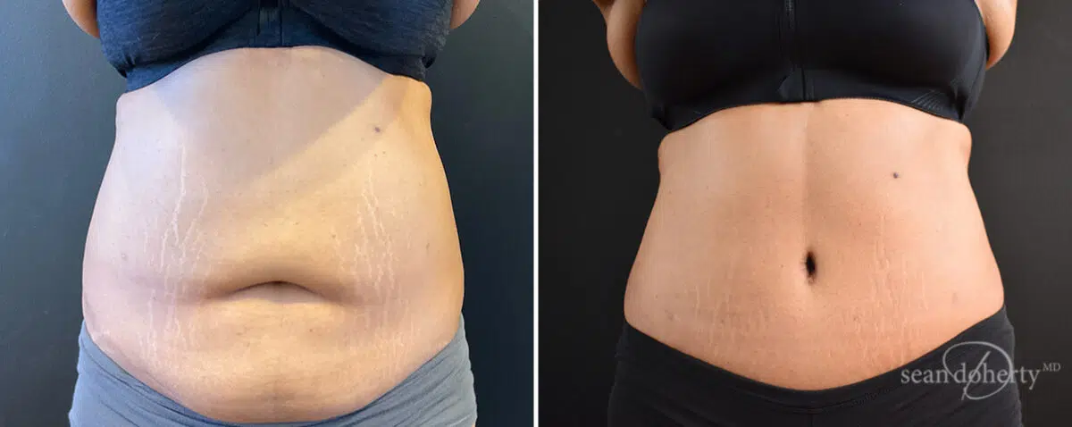 Tummy Tuck Before and After Photos in Boston, MA, Patient 14411