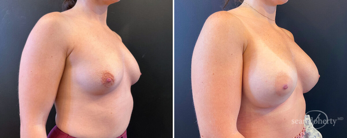Breast Augmentation Before and After Photos in Boston, MA, Patient 14447