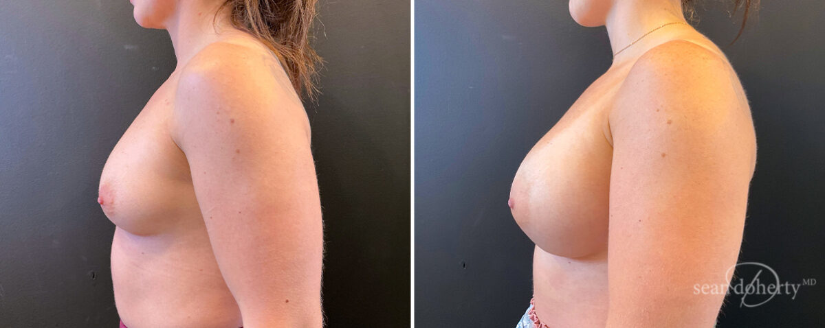 Breast Augmentation Before and After Photos in Boston, MA, Patient 14447