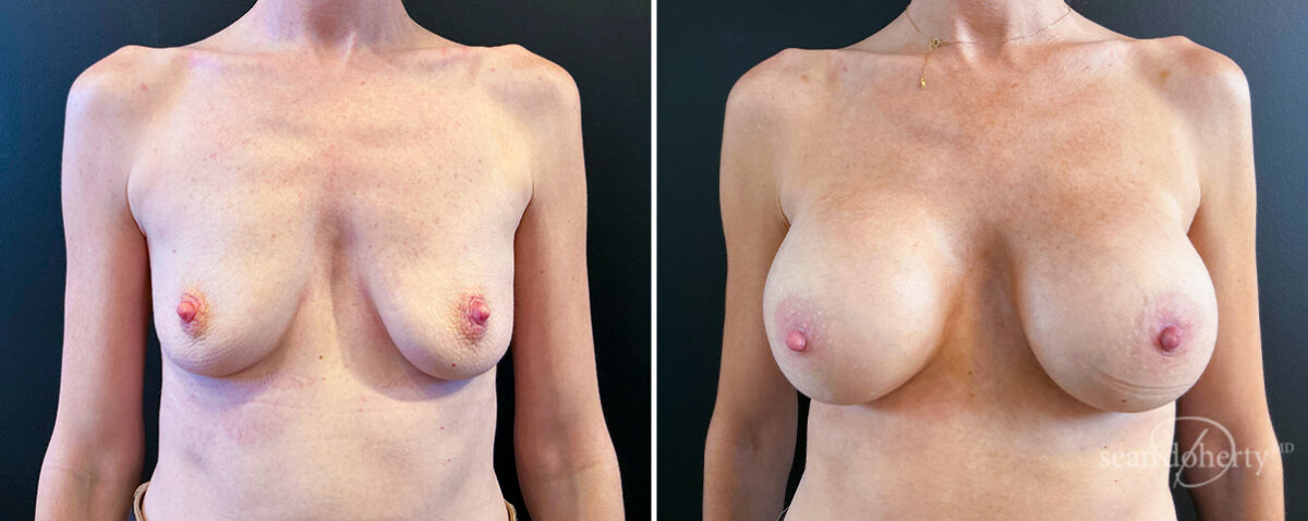 Breast Augmentation Before and After Photos in Boston, MA, Patient 14457