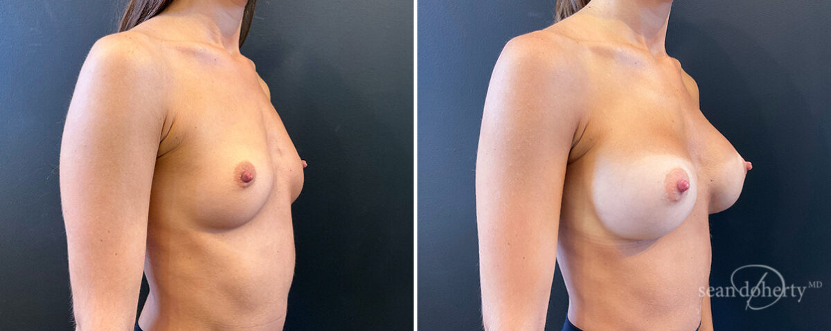 Breast Augmentation Before and After Photos in Boston, MA, Patient 14467