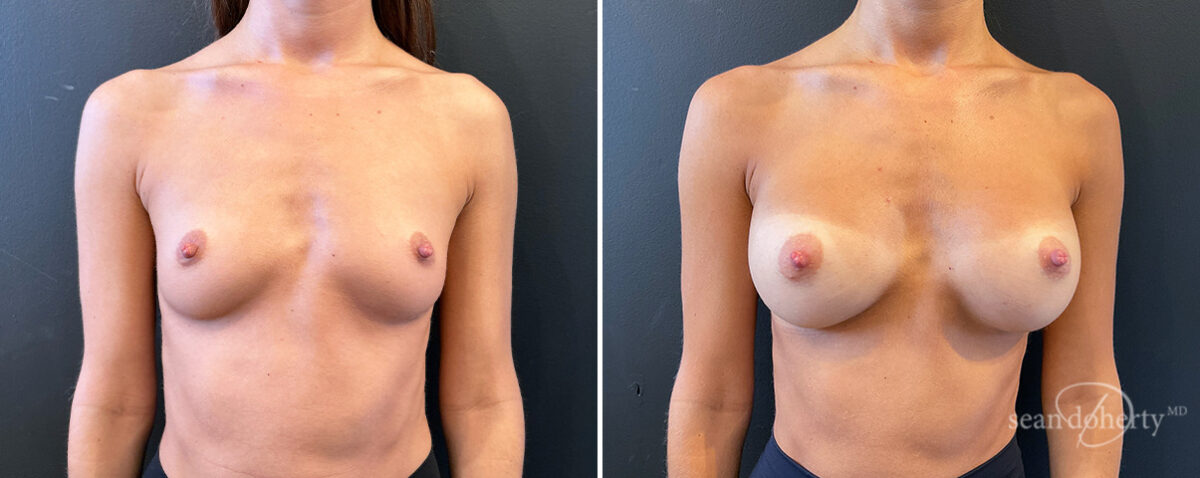 Breast Augmentation Before and After Photos in Boston, MA, Patient 14467