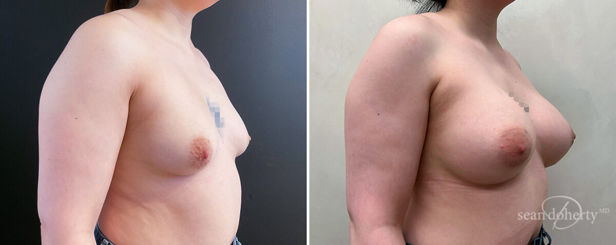 Breast Augmentation Before and After Photos in Boston, MA, Patient 14477
