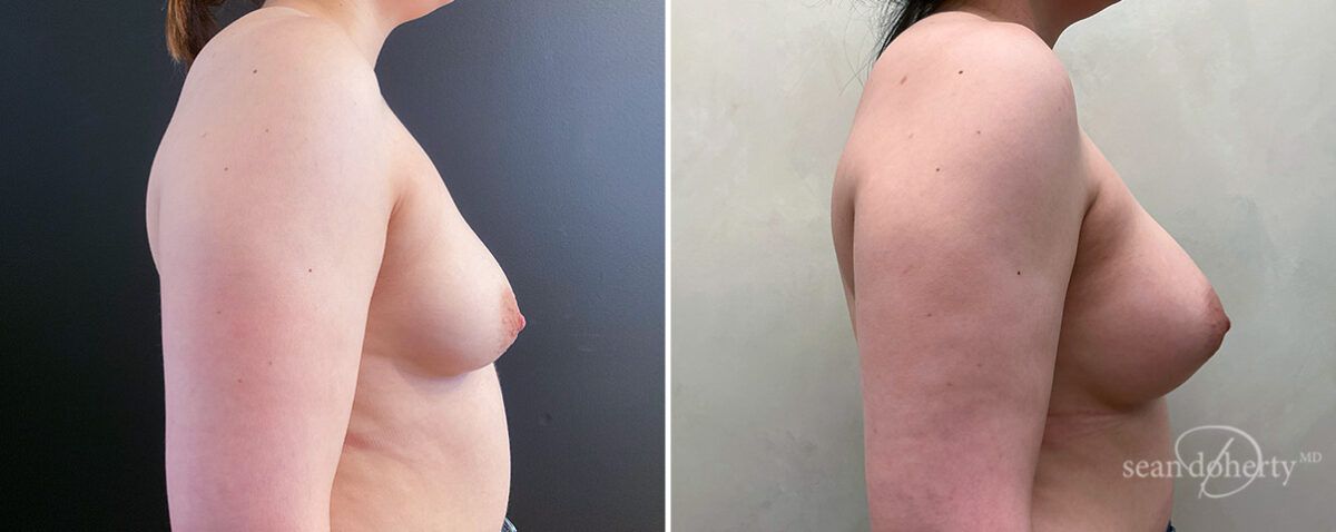 Breast Augmentation Before and After Photos in Boston, MA, Patient 14477