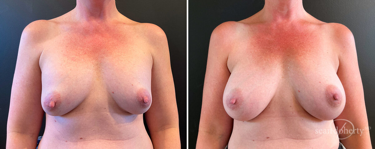 Breast Implant Exchange Before and After Photos in Boston, MA, Patient 14487