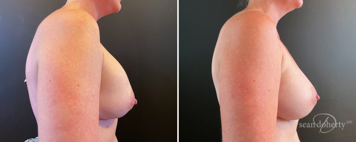 Breast Implant Exchange Before and After Photos in Boston, MA, Patient 14487