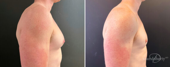 Gynecomastia Before and After Photos in Boston, MA, Patient 14517