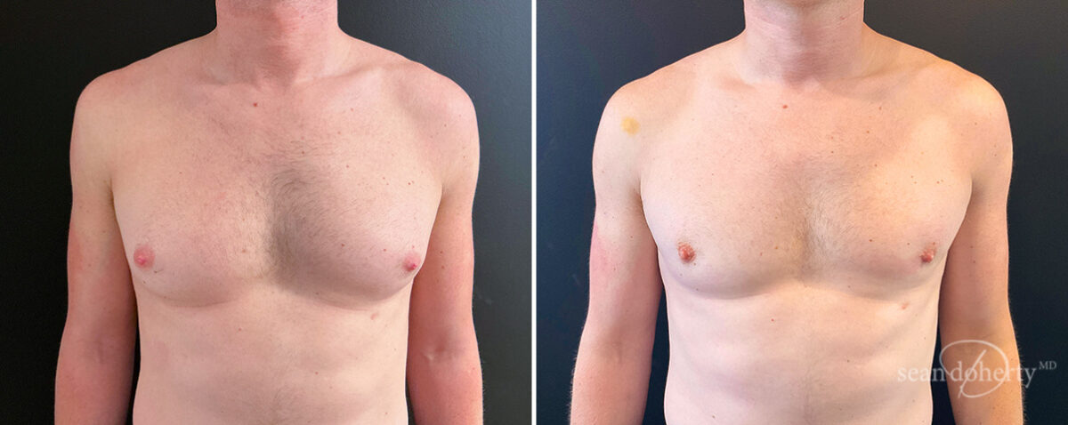 Gynecomastia Before and After Photos in Boston, MA, Patient 14517