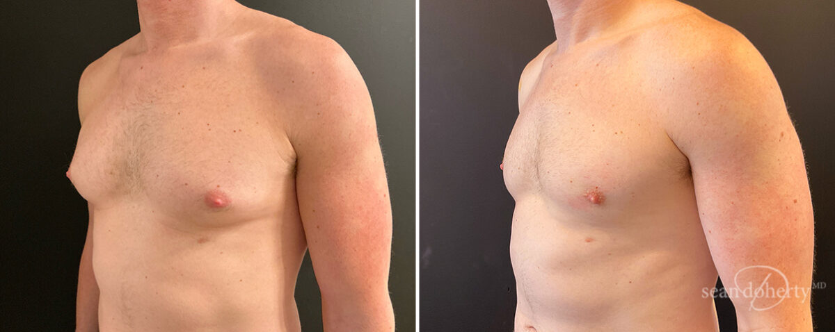 Gynecomastia Before and After Photos in Boston, MA, Patient 14517