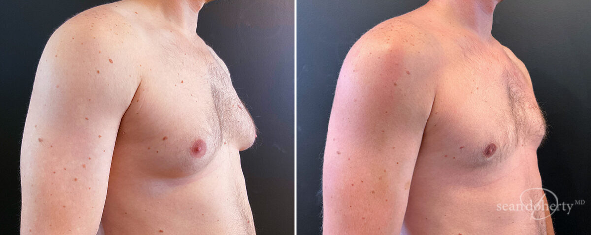 Gynecomastia Before and After Photos in Boston, MA, Patient 14527