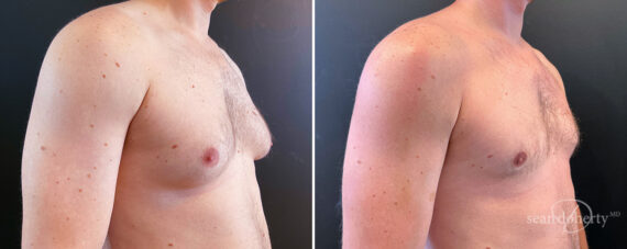 Gynecomastia Before and After Photos in Boston, MA, Patient 14527