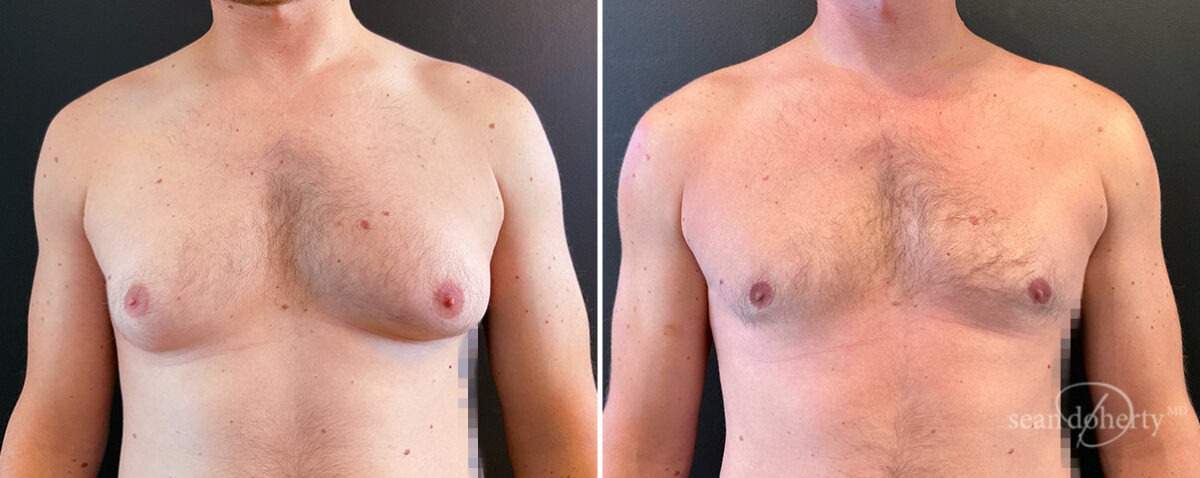 Gynecomastia Before and After Photos in Boston, MA, Patient 14527
