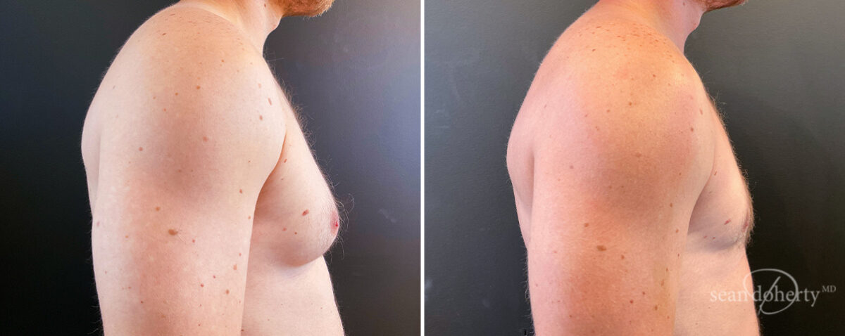 Gynecomastia Before and After Photos in Boston, MA, Patient 14527
