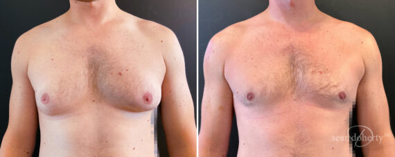 Gynecomastia Before and After Photos in Boston, MA, Patient 14527