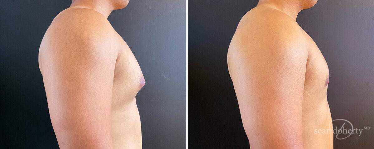 Gynecomastia Before and After Photos in Boston, MA, Patient 14538