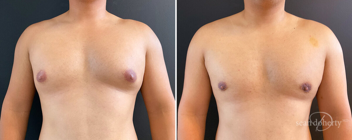 Gynecomastia Before and After Photos in Boston, MA, Patient 14538