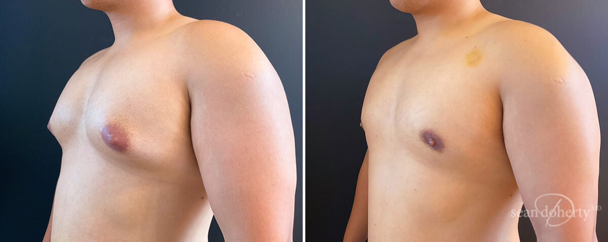 Gynecomastia Before and After Photos in Boston, MA, Patient 14538