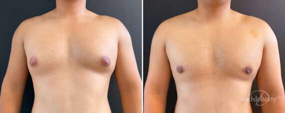 Gynecomastia Before and After Photos in Boston, MA, Patient 14538