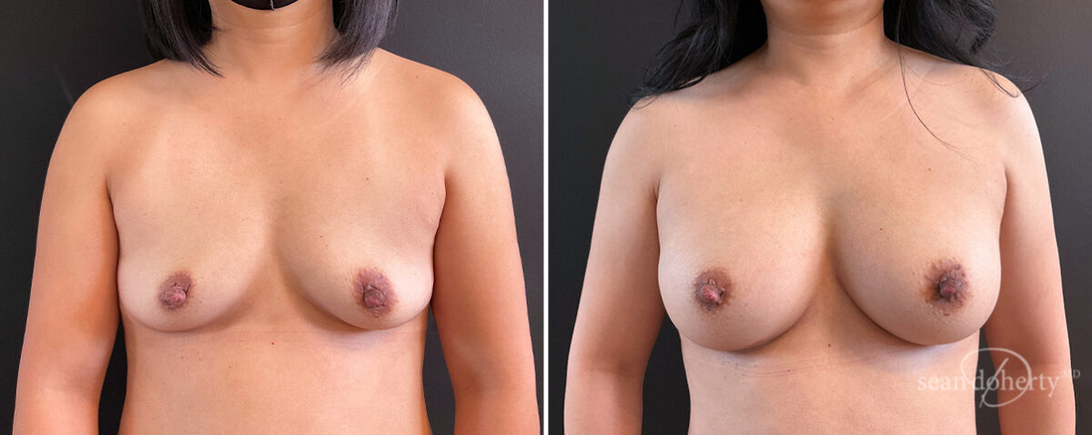 Breast Augmentation Before and After Photos in Boston, MA, Patient 14549