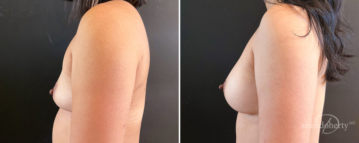 Breast Augmentation Before and After Photos in Boston, MA, Patient 14549