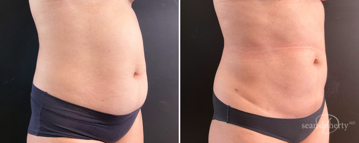 Liposuction Before and After Photos in Boston, MA, Patient 14562