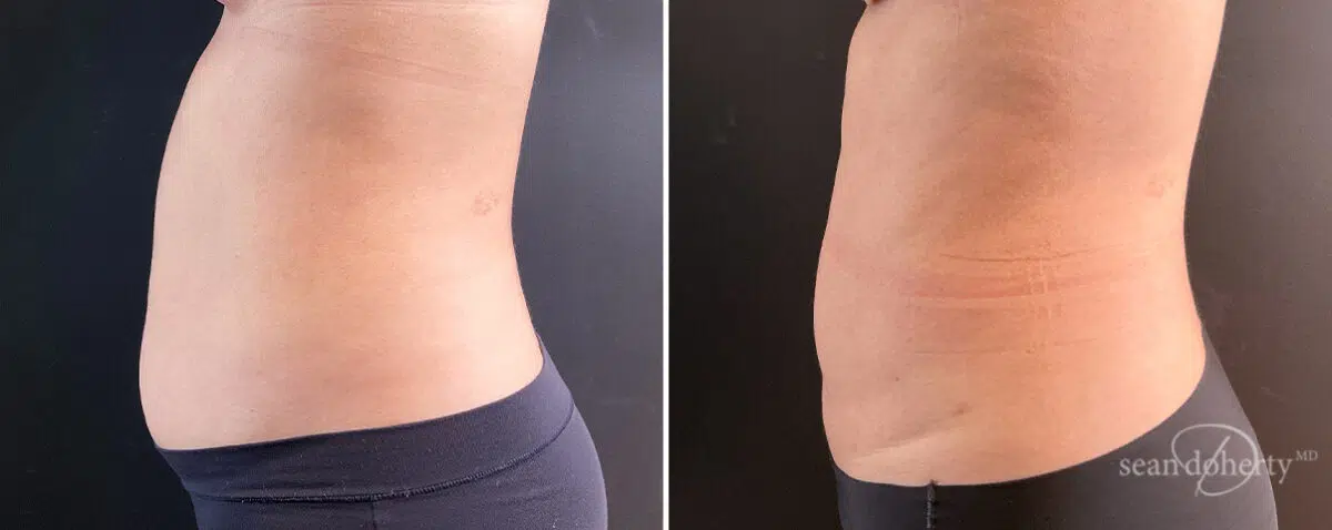 Liposuction Before and After Photos in Boston, MA, Patient 14562