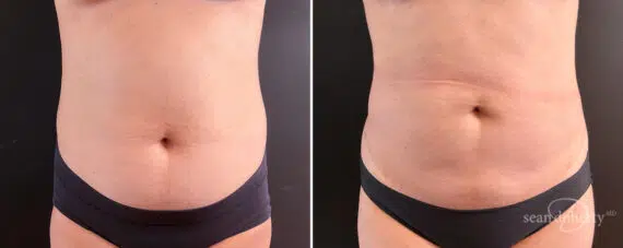 Liposuction Before and After Photos in Boston, MA, Patient 14562