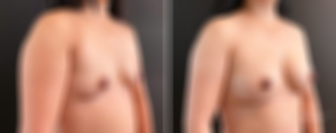 Mommy Makeover Before and After Photos in Boston, MA, Patient 14572