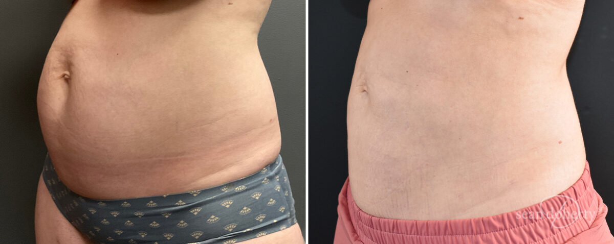 Mommy Makeover Before and After Photos in Boston, MA, Patient 14688