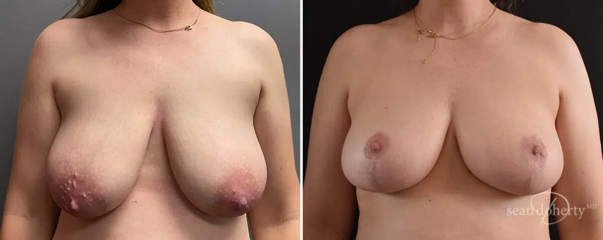 Mommy Makeover Before and After Photos in Boston, MA, Patient 14688