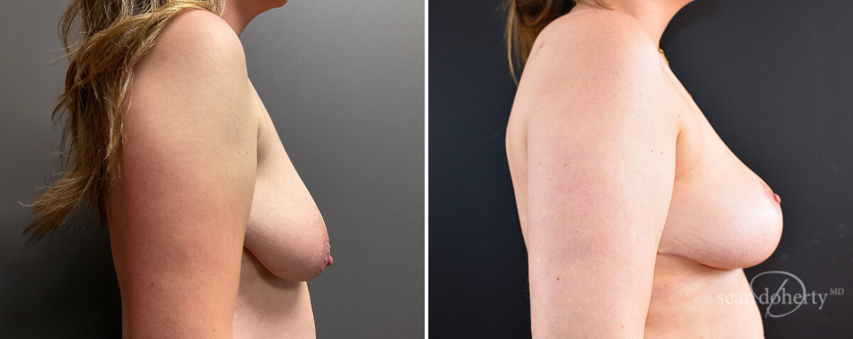 Mommy Makeover Before and After Photos in Boston, MA, Patient 14688