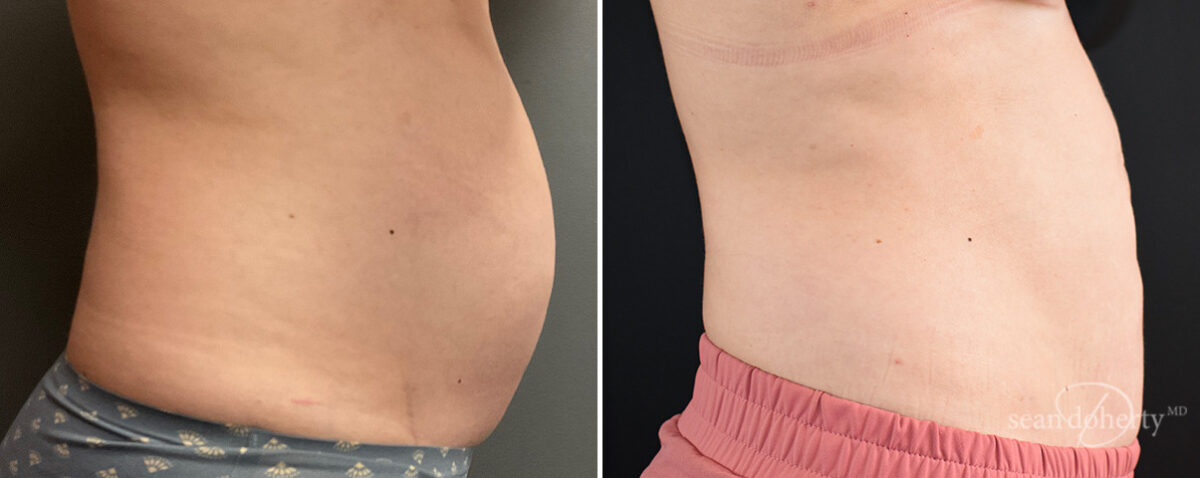 Mommy Makeover Before and After Photos in Boston, MA, Patient 14688