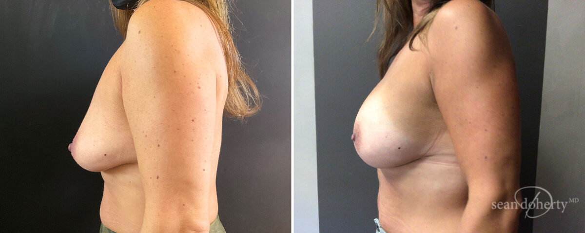 Breast Augmentation Before and After Photos in Boston, MA, Patient 14710