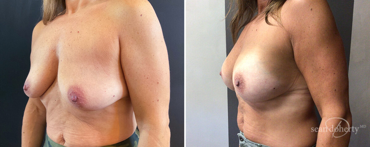 Breast Augmentation Before and After Photos in Boston, MA, Patient 14710