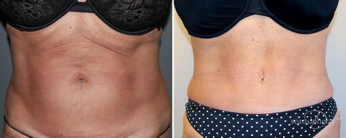 Mommy Makeover Before and After Photos in Boston, MA, Patient 14720